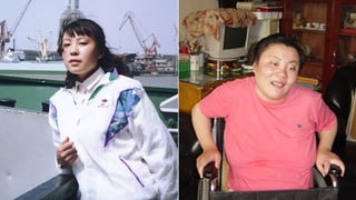Picture of Thallium poisoning case of Zhu Ling