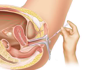 Picture of intrauterine insemination