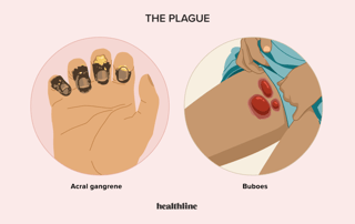 Picture of plague