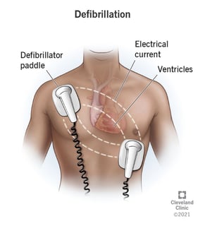 Picture of Defibrillation