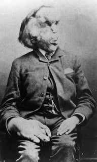 Picture of Joseph Merrick