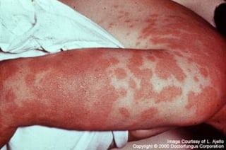 Picture of coccidioidomycosis