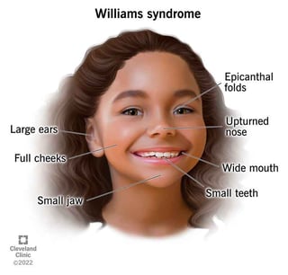 Picture of Williams-Beuren syndrome