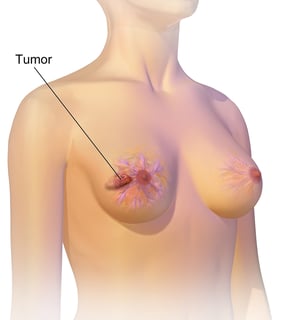 Picture of breast