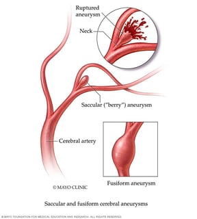 Picture of intracranial aneurysm