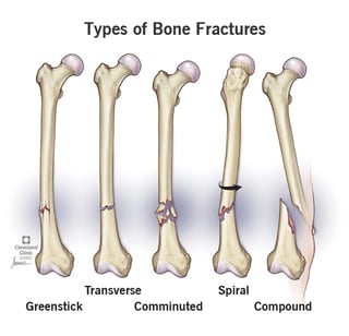 Picture of Fracture