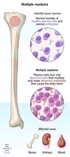 Picture of multiple myeloma