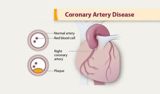 Picture of Coronary artery disease