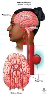Picture of aneurysm