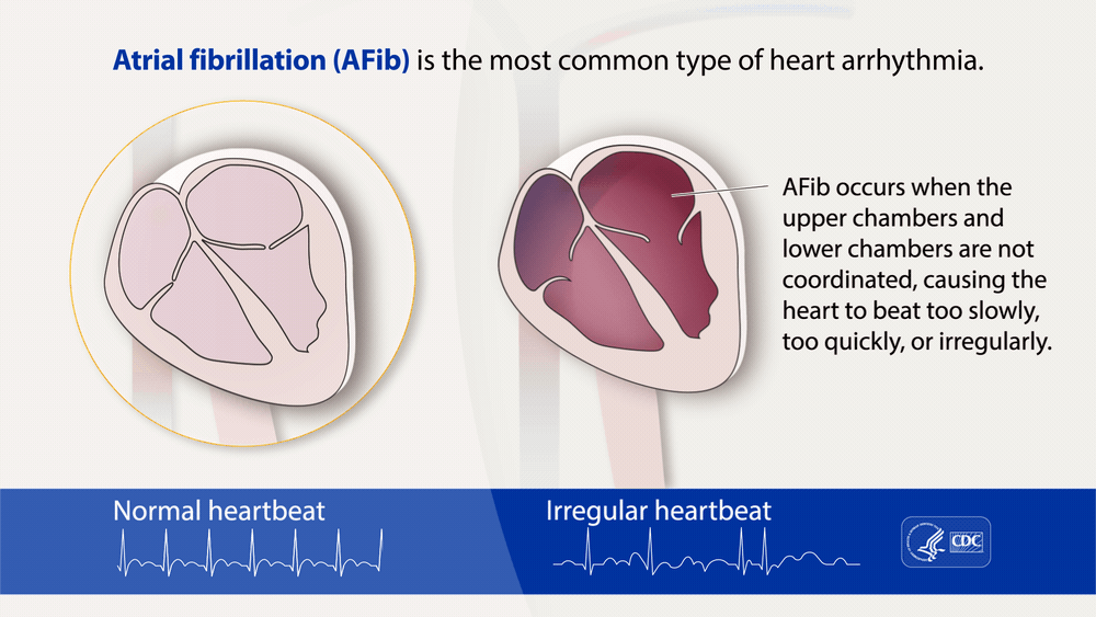 Picture of atrial fibrillation