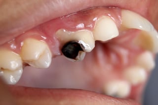 Picture of dental caries