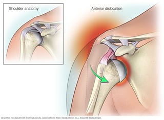 Picture of dislocated shoulder