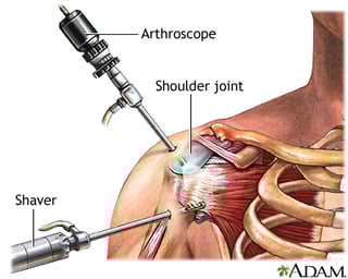 Picture of Shoulder surgery