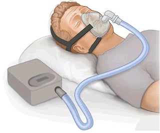 Picture of Continuous positive airway pressure