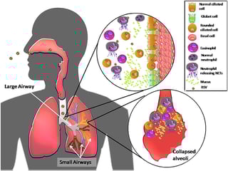 Picture of human respiratory syncytial virus