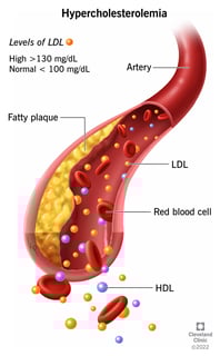 Picture of hypercholesterolemia