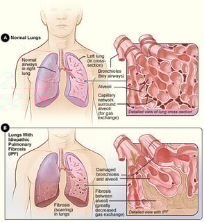 Picture of idiopathic pulmonary fibrosis