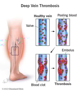 Picture of deep vein thrombosis