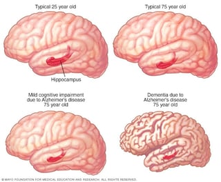 Picture of mild cognitive impairment