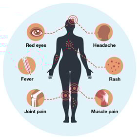 Picture of Zika fever