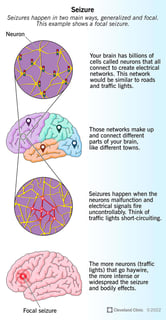Picture of epilepsy