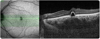 Picture of Optical coherence tomography