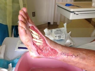 Picture of snakebite