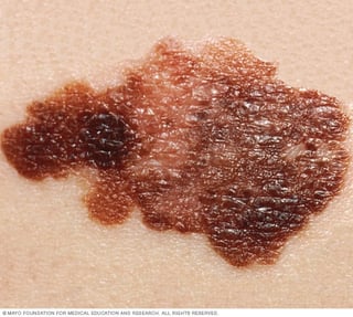 Picture of melanoma
