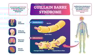 Picture of Guillain–Barré syndrome