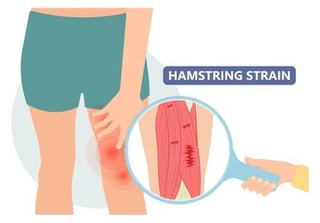 Picture of Pulled hamstring