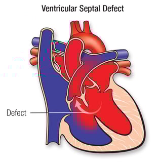 Picture of ventricular septal defect