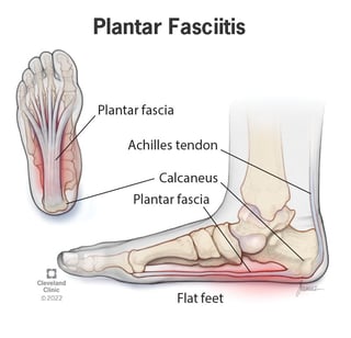 Picture of Plantar fasciitis
