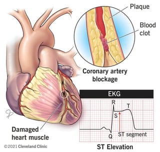 Picture of ST segment elevation myocardial infarction