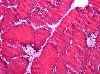 Picture of glycogen storage disease II