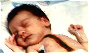 Picture of Baby Fae