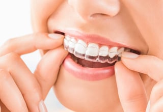 Picture of Clear aligners