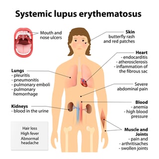 Picture of systemic lupus erythematosus