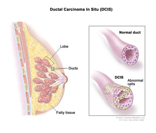 Picture of intraductal carcinoma