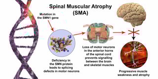 Picture of Spinal muscular atrophy