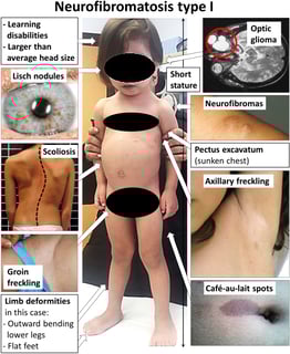Picture of neurofibromatosis type I