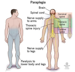Picture of paralysis