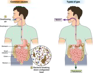 Picture of Flatulence