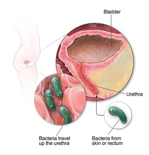 Picture of urinary tract infection
