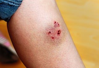 Picture of dog bite