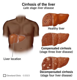 Picture of liver cirrhosis