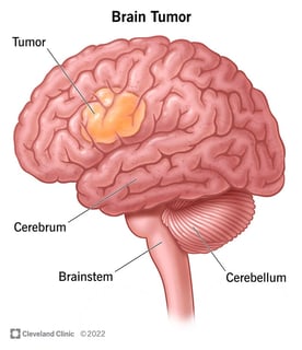 Picture of brain tumor