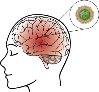 Picture of encephalitis