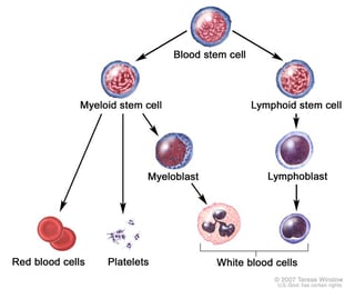 Picture of acute myeloid leukemia