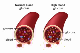 Picture of diabetes