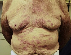 Picture of leprosy